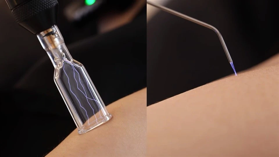 Fractional Cold Plasma high quality
