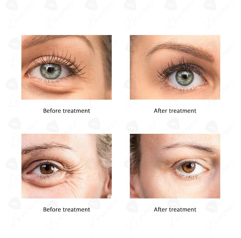Comparison of treatment effects Comparison of treatment effects